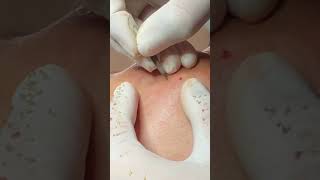 Best Pimple Popping 21 beautiful blackheads sacdepspa reels cute facts best [upl. by Sisxela]