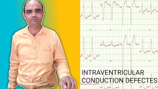 INTRAVENTRICULAR CONDUCTION DEFECTES [upl. by Waddington]