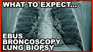 What to expect Bronchoscopy Lung Biopsy EBUS Procedure [upl. by Shae]