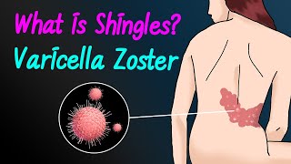 What is Varicella ZosterShingles [upl. by Yesnnyl]