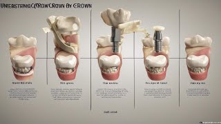 Understanding Dental Crown Costs  How Much Should You Expect to Pay [upl. by Oleusnoc]