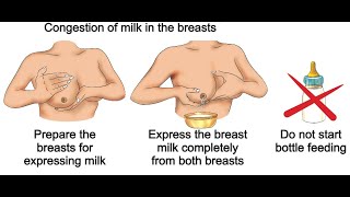 BFHI SESSION 10  BREASTFEEDING ISSUES  CRACK NIPPLE BREAST ENGORGEMENT MASTITIS BREAST ABSCESS [upl. by Ronnica]