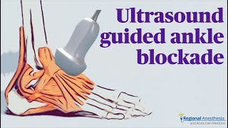 Ultrasound Guided Ankle Block [upl. by Hoffer]