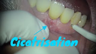 Abcès dentaire sous couronne  partie 2  traitement endodontique [upl. by Jasen]