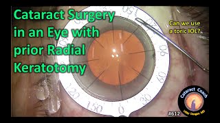 Toric IOL for astigmatism treatment after radial keratotomy [upl. by Shelbi]