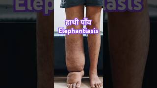 हाथी पांव Elephantiasis ये कौन सी बीमारी है filaria [upl. by Ginsburg]