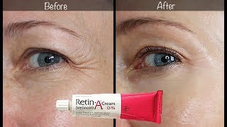 5Year RetinA Update  Before amp After for Wrinkles amp AntiAging [upl. by Constantia]