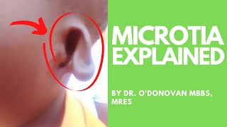 Explaining Microtia an abnormally shaped ear with Dr ODonovan [upl. by Hanahsuar]