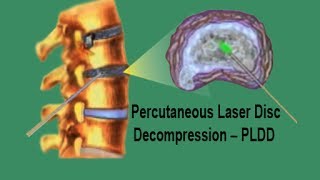 PLDD  Percutaneous Laser Disc Decompression [upl. by Bang555]