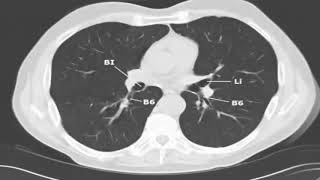 CT lung segments of bronchus [upl. by Eardnaed]