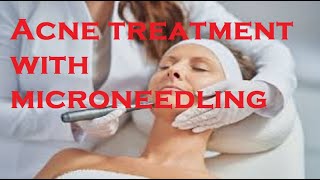 Acne treatment with microneedling [upl. by Mairim701]