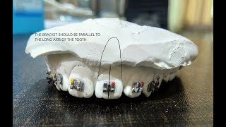 Orthodontic Bracket Positioning  Maxillary Teeth [upl. by Yrelav151]