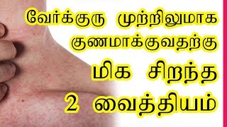 Home remedies for prickly heat Prickly heat rash Verkuru poga tips in Tamil [upl. by Sprage]