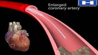 How Balloon Angioplasty is Done Animation  Coronary Angiography Procedure  Stenting in Heart Video [upl. by Friedberg]