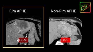 5 LIRADS Malignant lesions that are not definitely HCC LRM  Part 1 By Dr Kathryn Fowler [upl. by Aicylla]