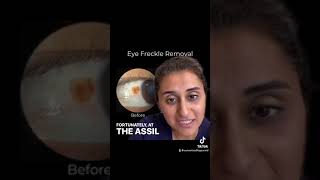 Nevus Removal Surgery Before and After  Assil Gaur Eye Institute NevusRemoval ophthalmology [upl. by Fihsak]