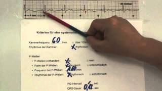 EKG für Pflege Teil 25  AVBlock 3 Grades interpretieren [upl. by Hinson786]