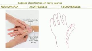 Seddons classification of nerve injurybackbenchers revolution [upl. by Snowber740]