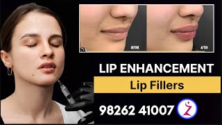 Lip Enhancement Procedures  Lip Fillers Treatments In Indore Delhi Mumbai Bangalore Hyderabad Surat [upl. by Annoed504]