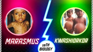 Marasmus and kwashiorkor nutritional deficiency diseases detailed explanation with pictures [upl. by Neenej]