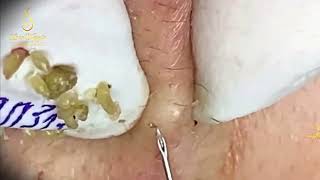 Top Acne Treatments That Work  Loan Nguyen [upl. by Ralaigh60]