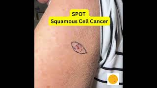 Squamous Cell Carcinoma arm Spot Skin Cancers [upl. by Solita]