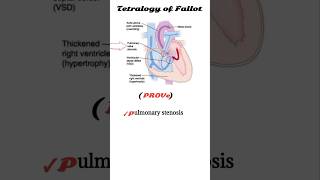 tetralogy of fallot mnemonic  TOF [upl. by Nirrek]