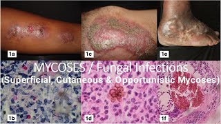 Mycoses  Fungal Infections  Superficial Cutaneous amp Opportunistic Mycoses  Microbiology Lecture [upl. by Ellenar224]