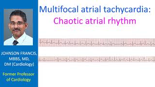 Multifocal atrial tachycardia Chaotic atrial rhythm [upl. by Eillil]