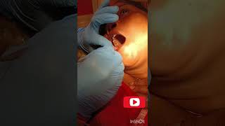 upper Third molar extraction [upl. by Eeryk]