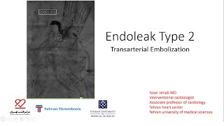 Endoleak Type 2 Transarterial Embolization [upl. by Gobert]