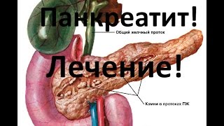 Панкреатит  причины симптомы и лечение [upl. by Suiramaj]