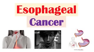 Esophageal Cancer  Risk Factors Pathogenesis Signs and Symptoms Diagnosis Treatment [upl. by Afaw]