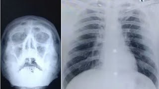 How to do x ray PNS and x ray chest [upl. by Ecyak]