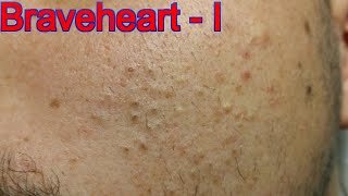 Extraction for Teenage Acne  Part 1 of 3 [upl. by Antonie731]