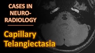 Cases in Neuroradiology Capillary Telangiectasia [upl. by Lednew529]