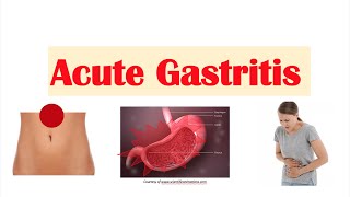 Acute Gastritis Stomach Inflammation  Causes Signs amp Symptoms Diagnosis Treatment [upl. by Afesoj]