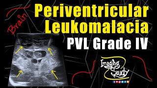 Periventricular Leukomalacia Grade IV  Ultrasound  Case 146 [upl. by Enait]