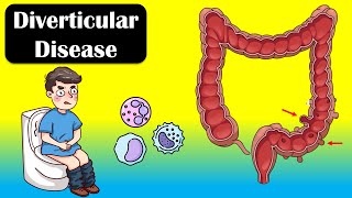 Diverticular Disease And Diverticulitis  Causes Signs amp Symptoms Diagnosis Treatment [upl. by Richy]