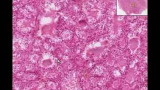 Histopathology ThyroidGraves Disease [upl. by Comstock]