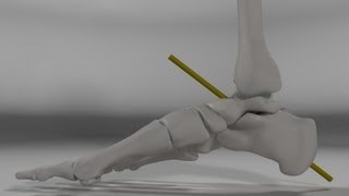 Over Pronation amp Supination Motion Biomechanics of the Subtalar Joint Explained [upl. by Llegna]