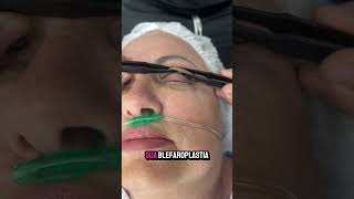 Pontos perfeitos de Blefaroplastia [upl. by Nesral]