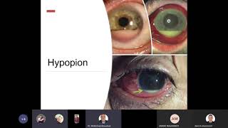 Lecture 6 Uveitis [upl. by Saville]