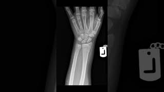 Colles fracture xraywrist [upl. by Craven]