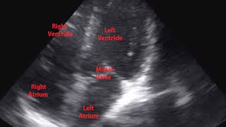 Echocardiogram of Premature Ventricular Contraction  Loop [upl. by Inalawi900]