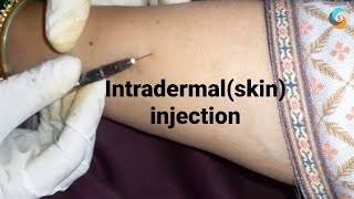 intradermal or skin injection [upl. by Nylrehs]