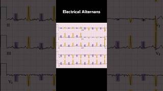 Electrical Alternans ECG Example 1 [upl. by Ahsatsan]