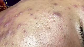 Loan Nguyen Acne Treatment 1623h [upl. by Olive274]