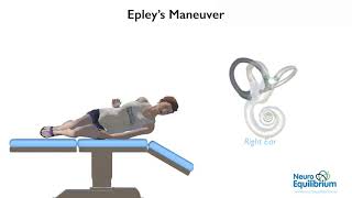 Epley Maneuver A Step by Step Guide to Treat BPPV Vertigo [upl. by Sheffy277]