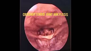 SEE WHAT ANKYLOSIS OF THE CRICOARYTENOID JOINT LOOKS LIKE [upl. by Rita]